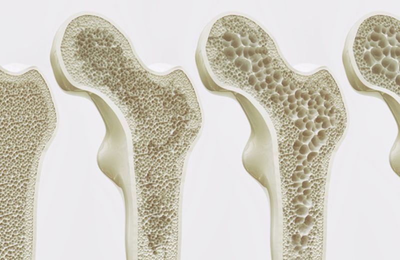 Osteoporosi Fisioterapia Cupelli